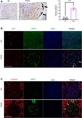 Nuclear Receptor Interacting Protein-2 Mediates the Stabilization and Activation of β-Catenin During Podocyte Injury